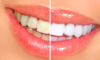 witte tanden zonder bleken