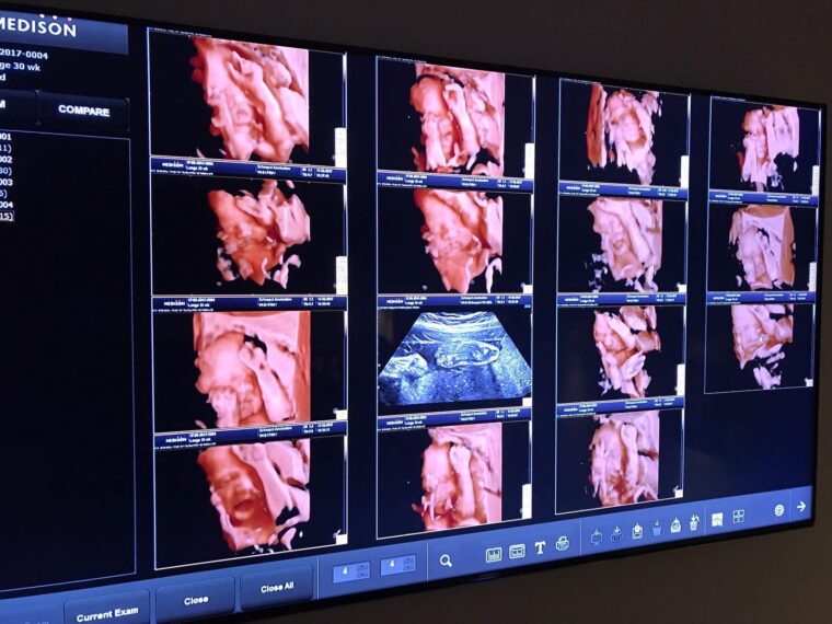 ZwangerschapsdagboekEen prachtige 3D:4D echo laten maken